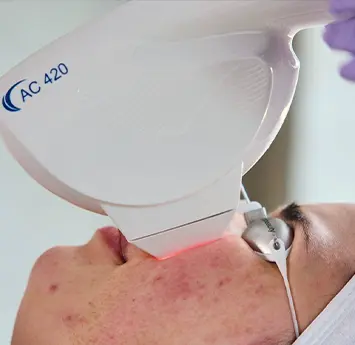 Acne Treatment with Laser